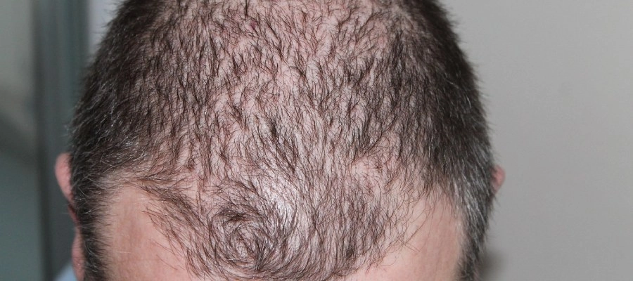 Imagem do post Queda de cabelo masculino: como retardar ou evitar esse processo?
